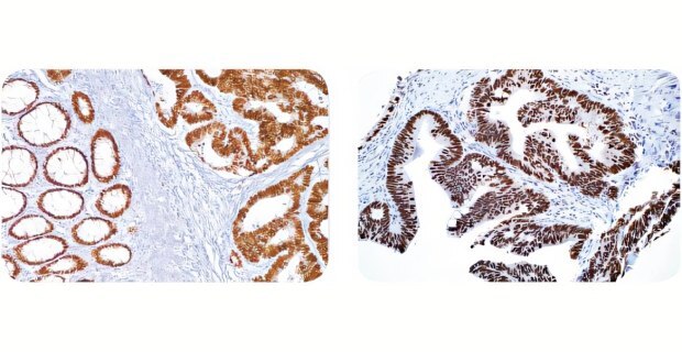 Cell Marque™ IVD antibody staining of colon carcinoma