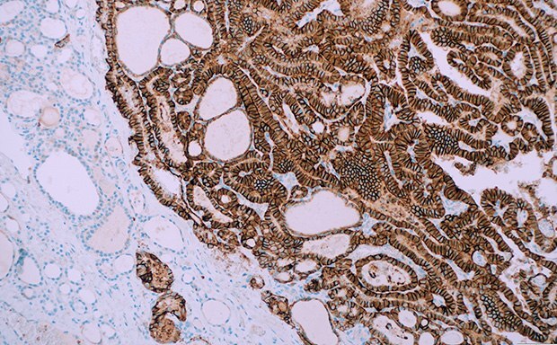 IHC staining of clinical tissue with a Cell Marque™ TROP2 antibody Cell Marque™ Primary Antibodies