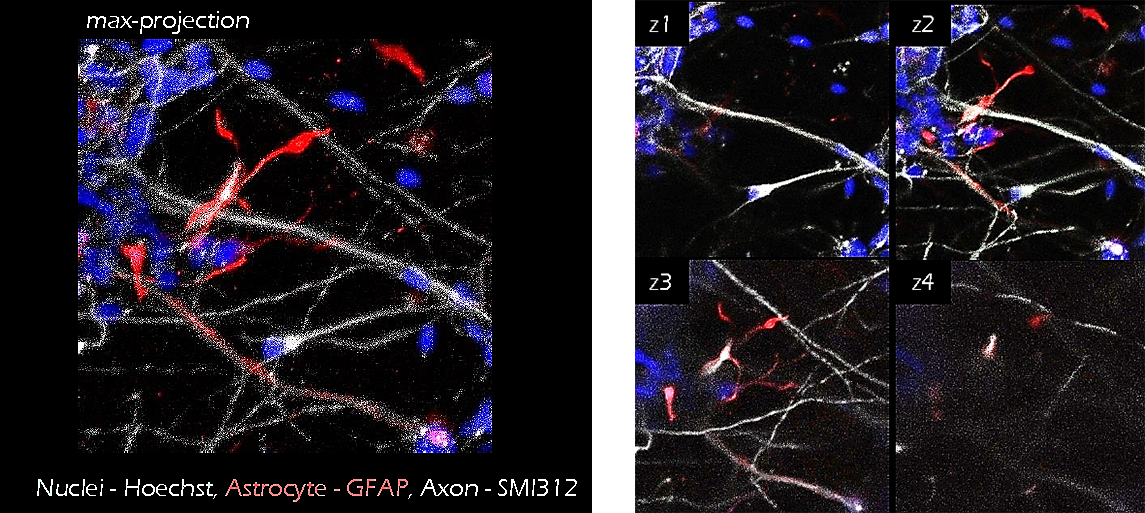 <a href="https://www.emdmillipore.com/US/en/product/Human-iPSC-Derived-Neural-Progenitors,MM_NF-SCC035" target="_blank">iPS cell derived neurons</a> (grey) and astrocytes (GFAP, red) were co-cultured in TrueGel3D<sup>®</sup> HTS Hydrogels for 15 days. The addition of astrocytes sequentially led to higher cell viabilities and enhanced neural activity (calcium signaling, data not shown) suggesting increased cell maturation. Application of TrueGel® HTS hydrogels in iPS neuron/astrocyte co-cultures