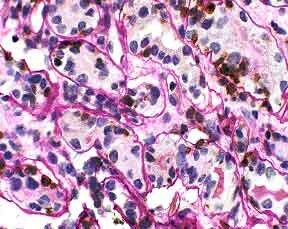 Tubulitis in the renal biopsy. Lymphocyte cytoplasm stains brown. Tubular borders are clearly delineated. UCHL-1/PASH 400x