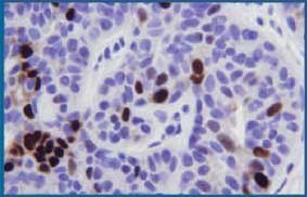 Routinely fixed and processed breast tissue stained with IHC for progesterone receptor protein. 400X