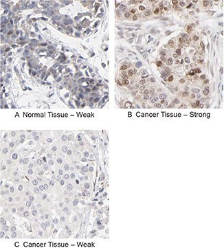 Immunohistochemical analysis using the Anti-RBM3 antibody (HPA003624) shows weak expression in normal breast tissue (A) and differential expression, varying from weak to strong in tumor breast samples (B, C). RBM3 Antibody