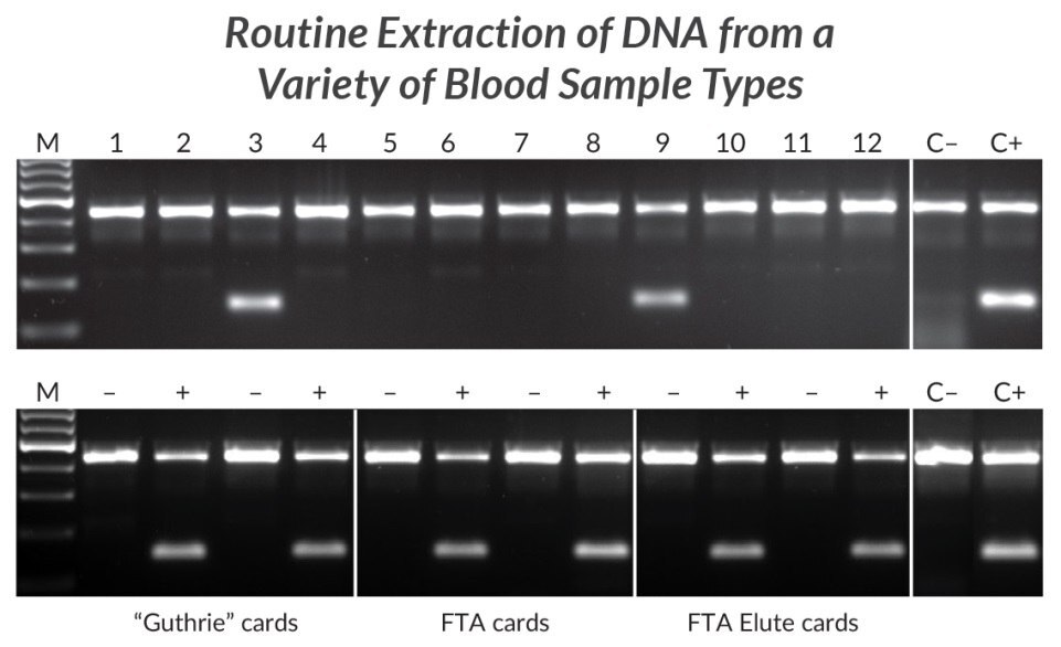 HLA-B*27対立遺伝子検出のためのさまざまな血液サンプル型からのDNAの抽出と増幅。