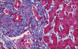 Trichrome Stain (Masson) Kit